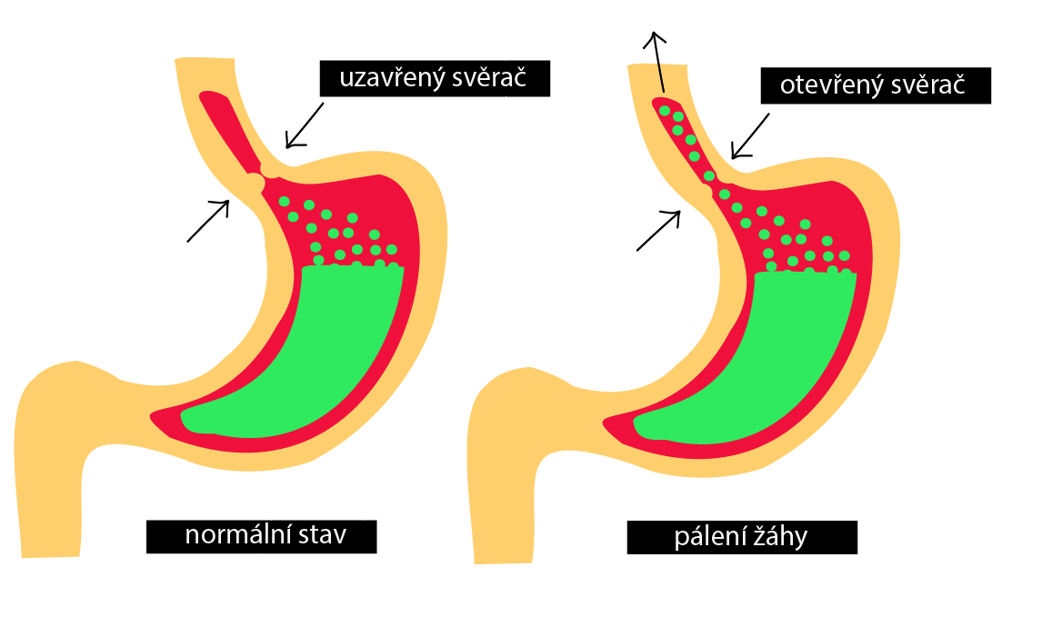 Co může způsobit reflux?